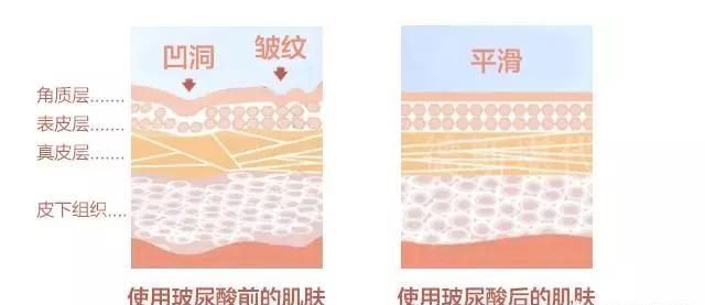 玻尿酸到底是啥,玻尿酸填充到底好不好图5
